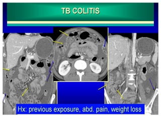 Presentation1, radiological imaging of colitis. | PPTX