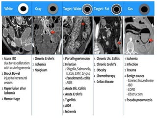 Presentation1, radiological imaging of colitis. | PPTX