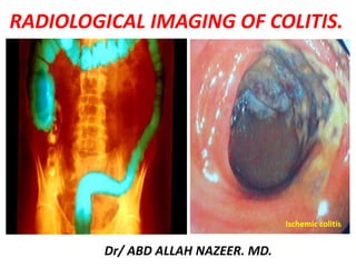 RADIOLOGICAL IMAGING OF COLITIS.
Dr/ ABD ALLAH NAZEER. MD.
Ischemic colitis
 