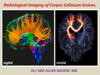 Radiological Imaging of Corpus Callosum lesions.
Dr/ ABD ALLAH NAZEER. MD.
 