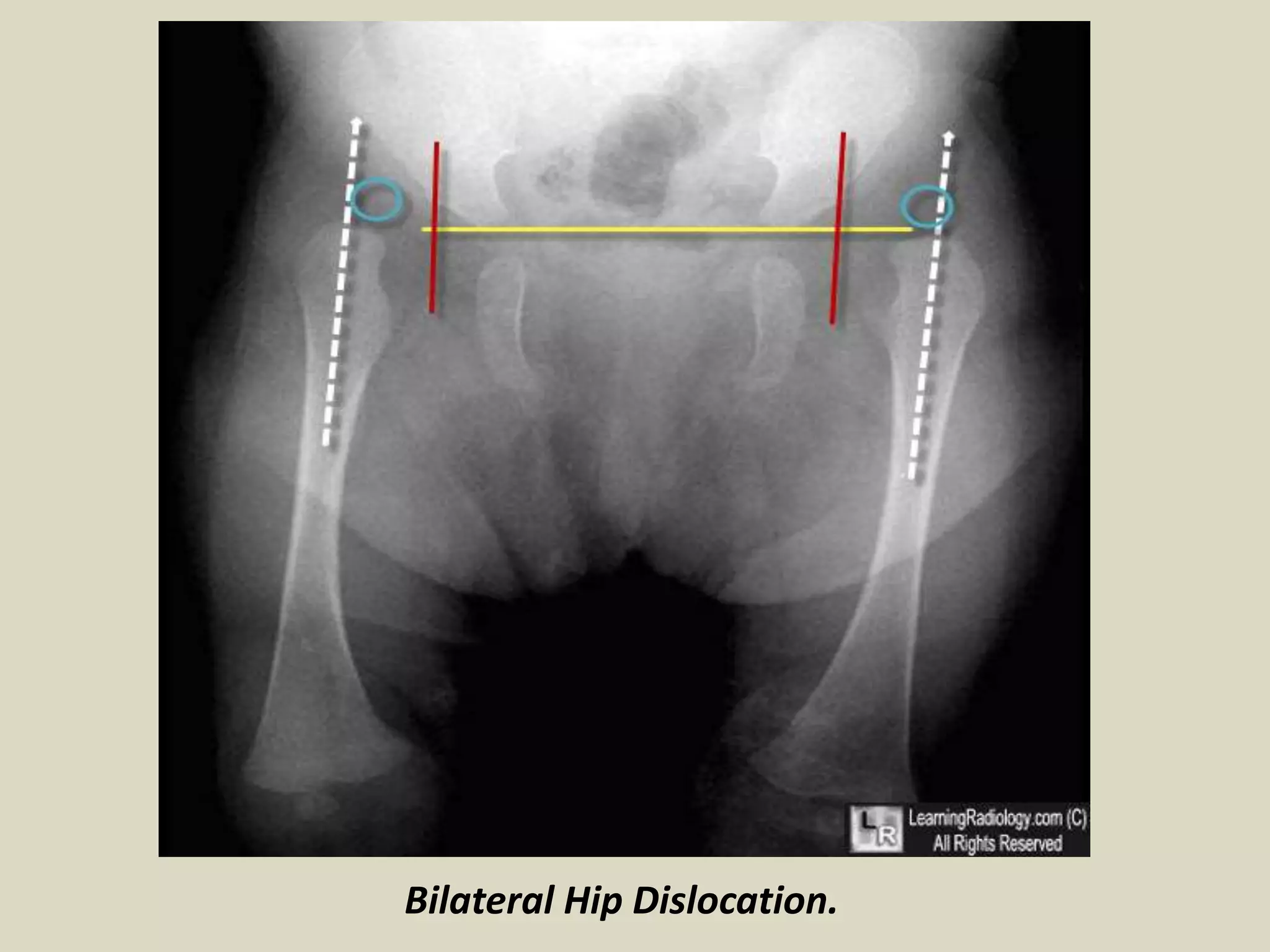 Presentation1 Radiological Imaging Of Developmental Dysplasia Of The Presentation1 Radiological Imaging Of Developmental Dysplasia Of The