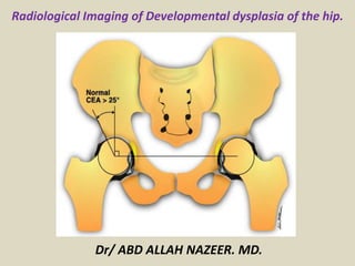 Radiological Imaging of Developmental dysplasia of the hip.
Dr/ ABD ALLAH NAZEER. MD.
 