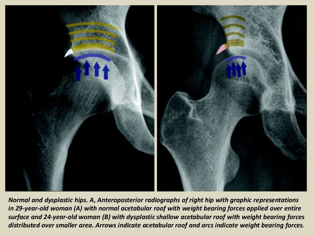 Presentation1, radiological imaging of developmental dysplasia of the…