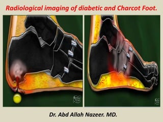 Radiological imaging of diabetic and Charcot Foot.
Dr. Abd Allah Nazeer. MD.
 