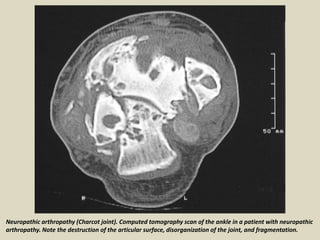 Presentation1, radiological imaging of diabetic foor and charcot joint ...
