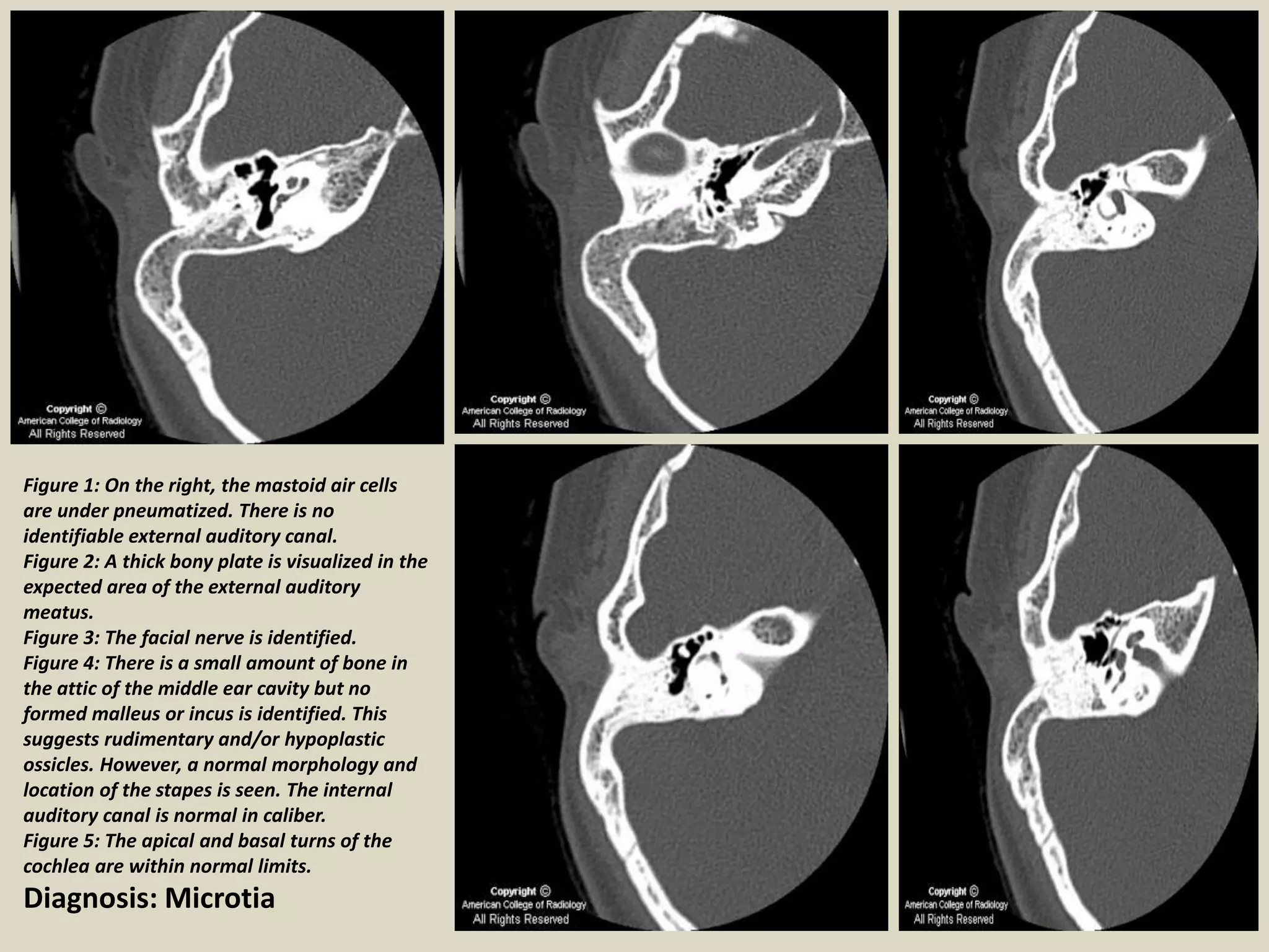 Microcus Ear Presentation1, radiological imaging of ear microcia. | PPT