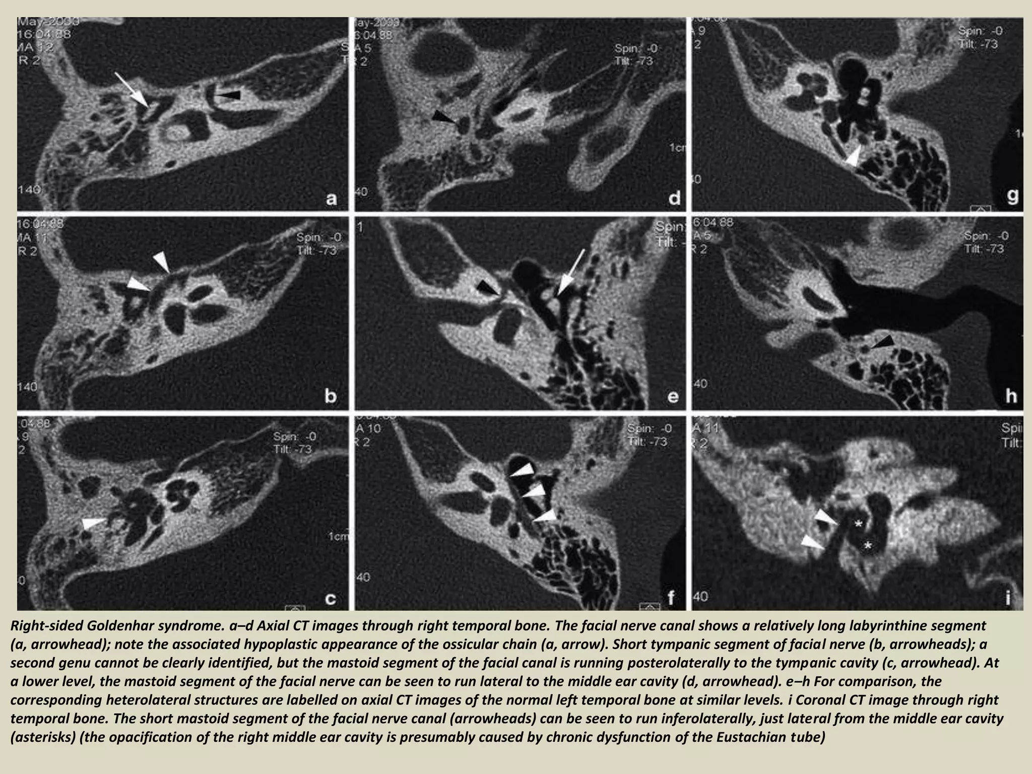 Microcus Ear Presentation1, radiological imaging of ear microcia. | PPT