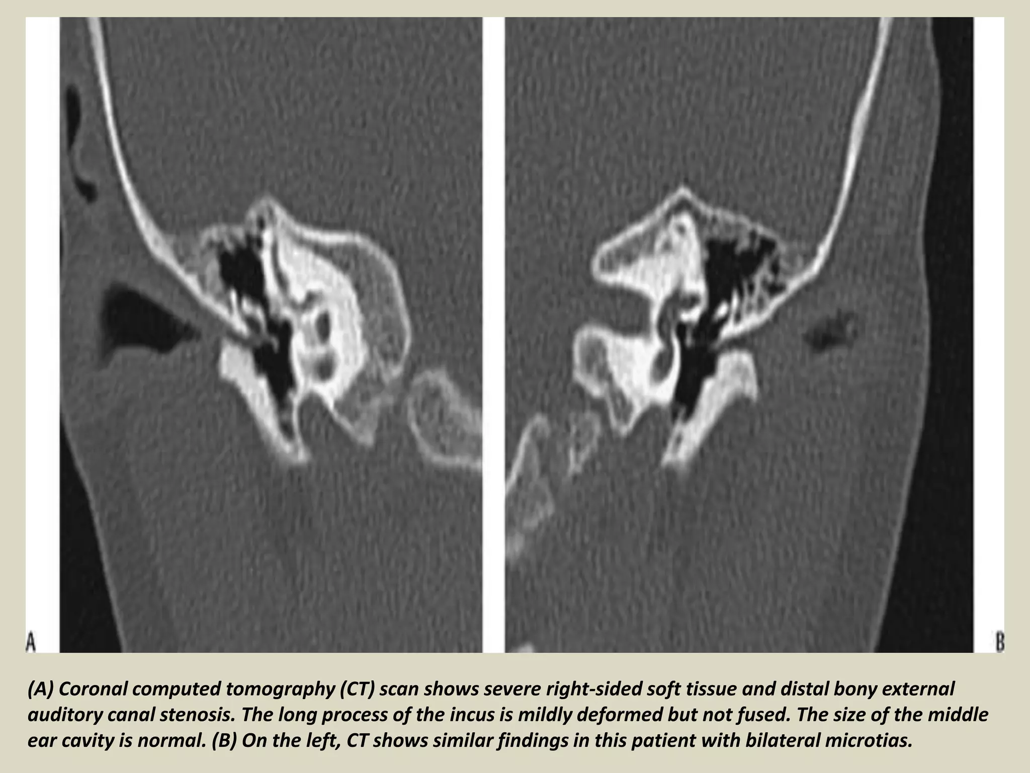 Microcus Ear Presentation1, radiological imaging of ear microcia. | PPT