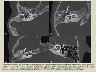 Dysplastic Incus Presentation1, radiological imaging of ear microcia. | PPTX