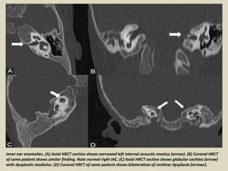 Microcus Ear Presentation1, radiological imaging of ear microcia. | PPTX