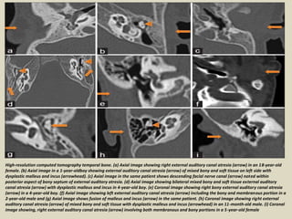 Dysplastic Incus Presentation1, radiological imaging of ear microcia. | PPTX