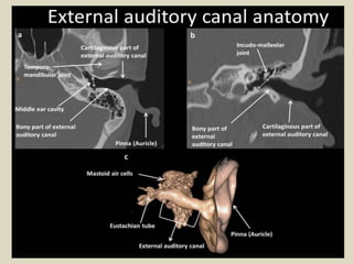 Microcus Ear Presentation1, radiological imaging of ear microcia. | PPTX