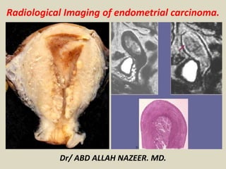 Dr/ ABD ALLAH NAZEER. MD.
Radiological Imaging of endometrial carcinoma.
 