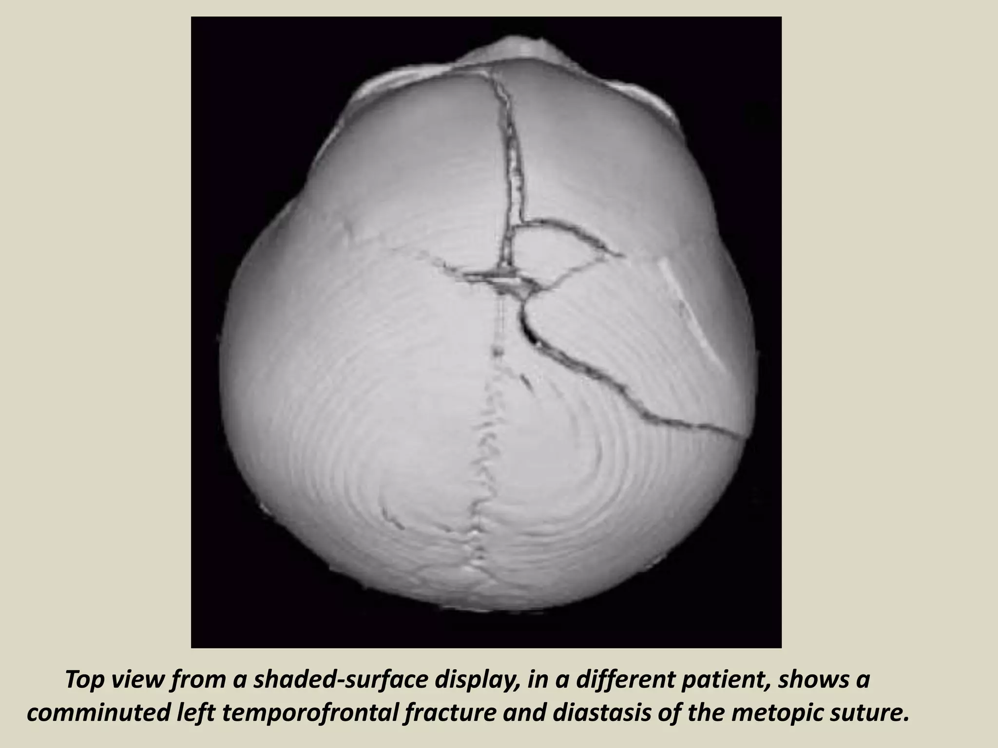 Presentation1, radiological imaging of fractures. | PPTX
