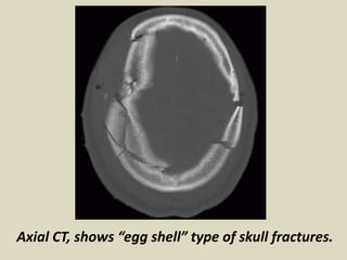 Eggshell Radiology Presentation1, radiological imaging of fractures. | PPTX
