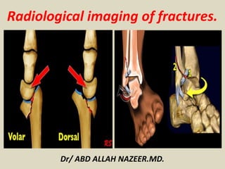 Dr/ ABD ALLAH NAZEER.MD.
Radiological imaging of fractures.
 