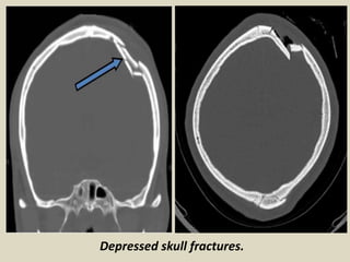 Depressed skull fracture in the simple X-ray and 3 dimensional computed tomography. A : Depressed
skull fracture on the pa...