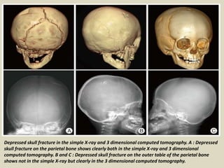 Axial brain and bone-window computed tomography scans show multiple fractures involving the
right temporal and parietal bo...