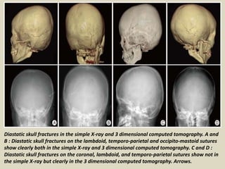 Basilar skull fractures are linear fractures that occur in the floor of
the cranial vault (skull base), which require more...