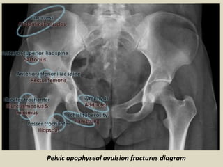 Transverse acetabular fracture.
Anteroposterior pelvic radiograph
(A), bilateral oblique pelvic
radiographs (B, C), axial ...