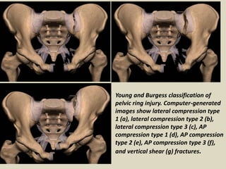 Isolated posterior wall acetabular fracture. Anteroposterior pelvic radiograph (A), bilateral oblique
pelvic radiographs (...