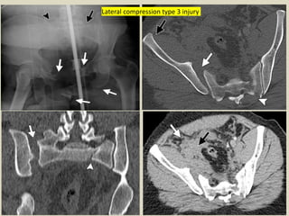 (A) Sagittal preoperative CT scan shows type 2 upper sacral fracture with a posterior displacement of the
upper fragment. ...