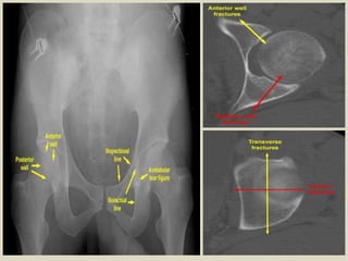 Four examples of posterior luxation (dislocation of a joint, with the lower joint surface slipping backwards)
 