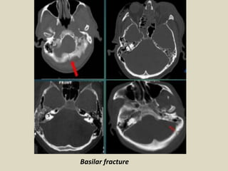 CT scan brain showing growing skull fracture with underlying
porencephalic cyst (a) before and (b) after repair Growing sk...