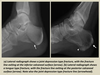 Presentation1, radiological imaging of fractures.