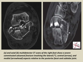 Presentation1, radiological imaging of fractures.