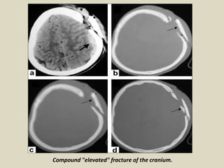 (a) Brain CT scan revealing a large depressed fracture over left frontal region; (b) Brain CT
scan with bone window to con...