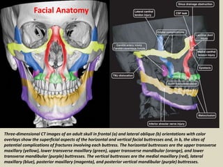 (a) Axial unenhanced CT image at an inferior level of the maxillary
sinuses demonstrates bilateral fractures through the p...