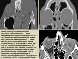 Mandibular fractures before and after internal
fixation. (a) Axial unenhanced CT image of the
mandible demonstrates a disp...