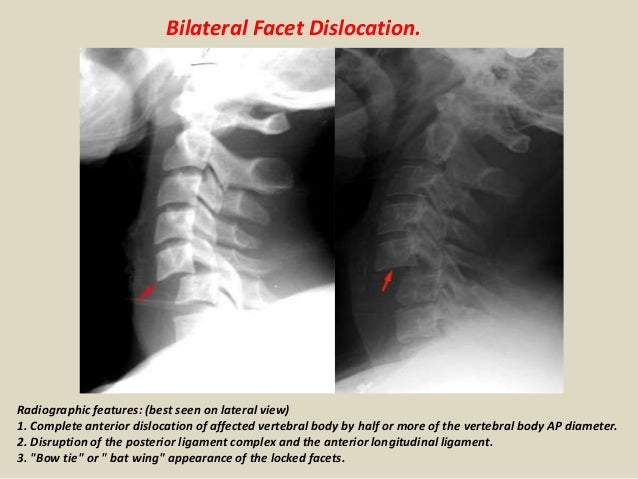Bilateral Facet Dislocation