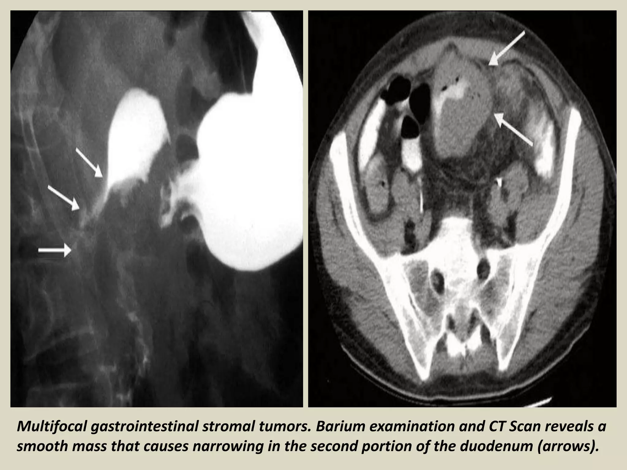 Presentation1, radiological imaging of gastro intestinal stromal tumour ...
