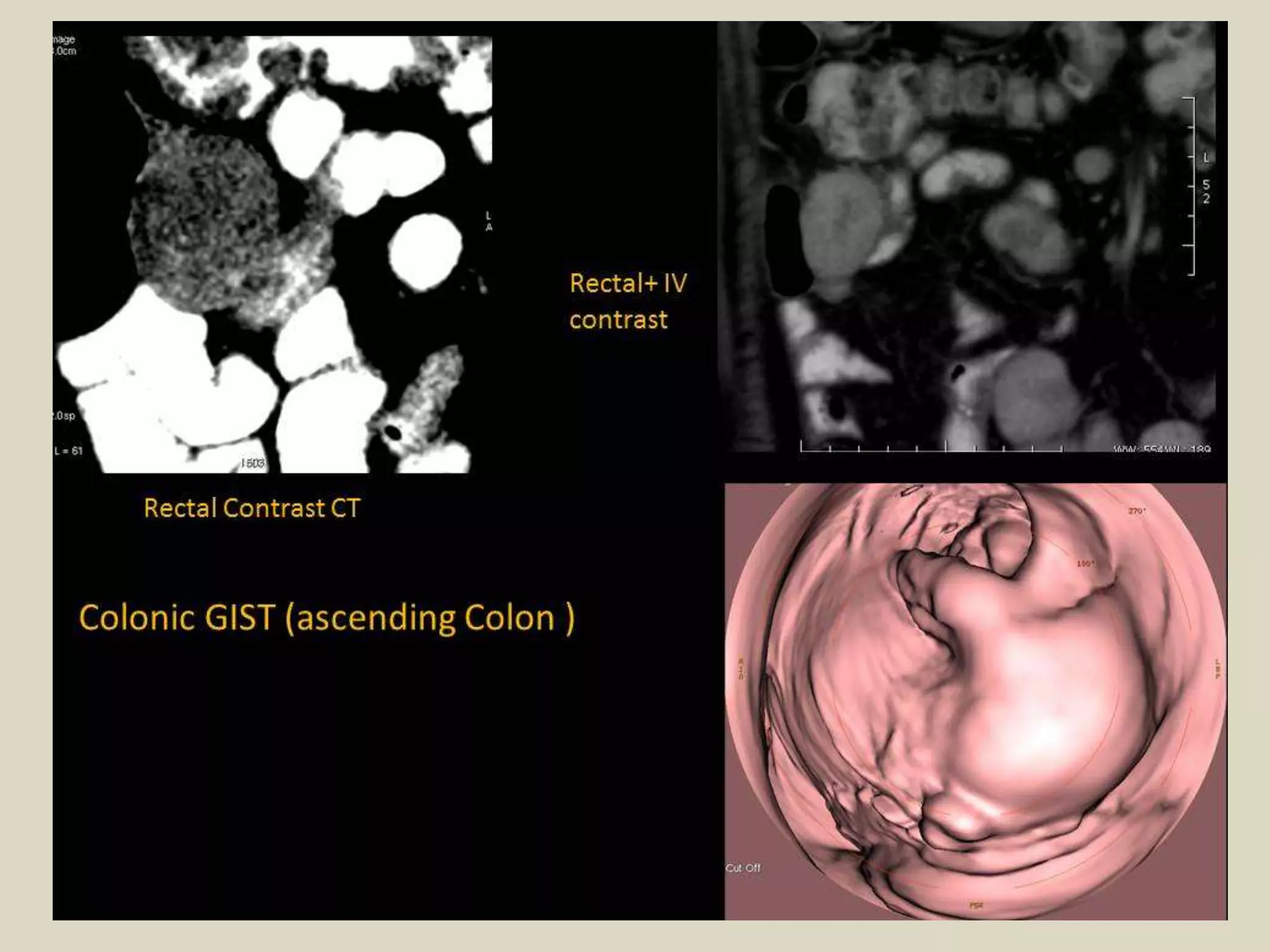 Presentation1, radiological imaging of gastro intestinal stromal tumour ...