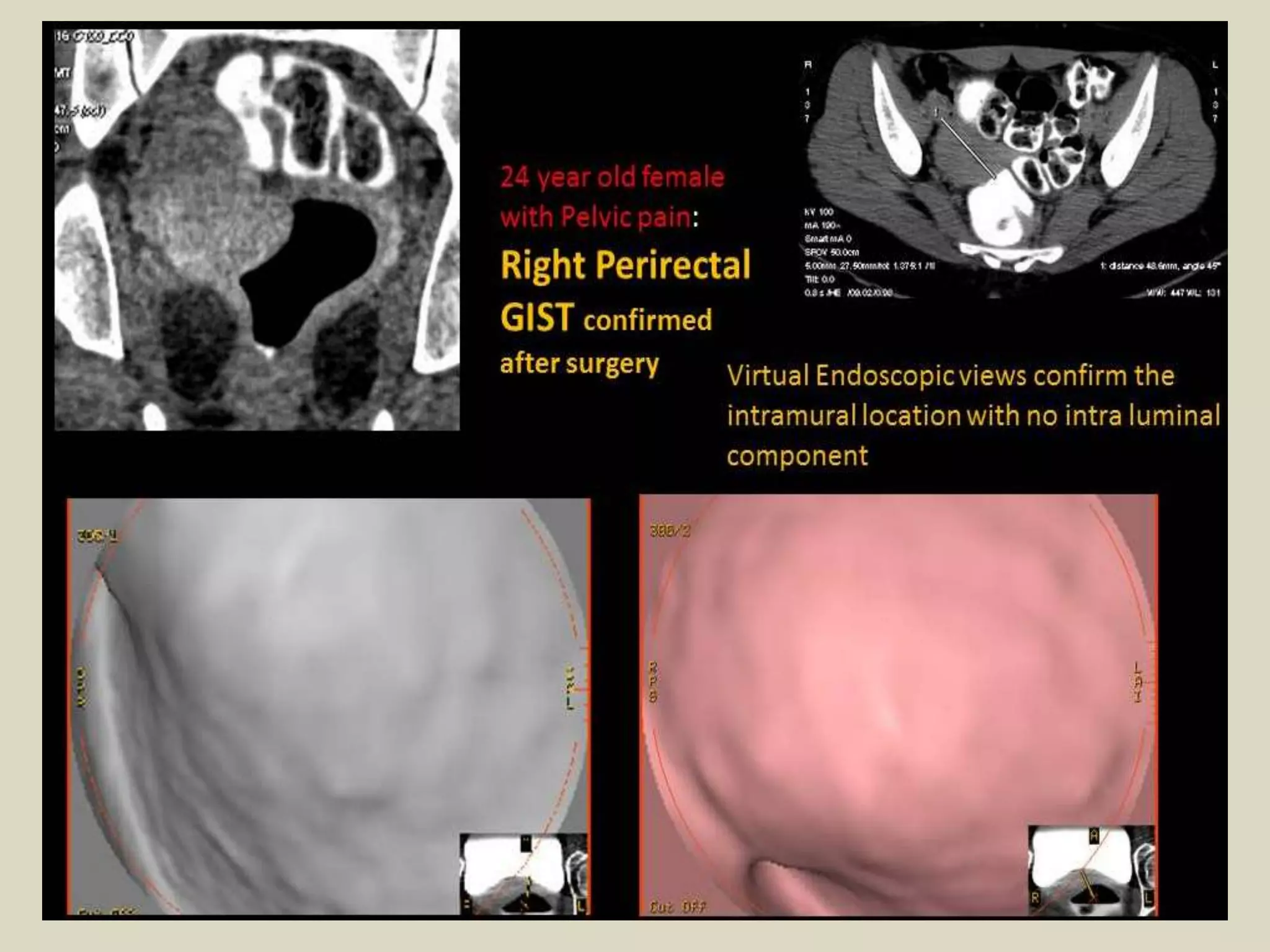 Presentation1, radiological imaging of gastro intestinal stromal tumour ...
