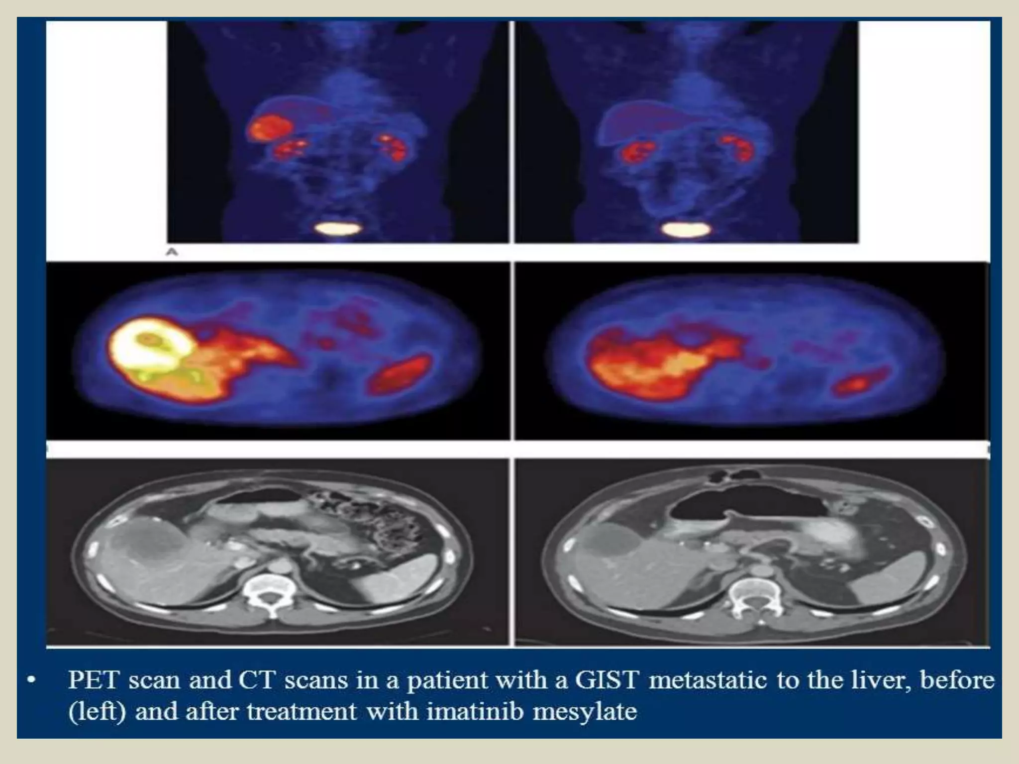 Presentation1, radiological imaging of gastro intestinal stromal tumour ...