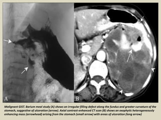 Presentation1, radiological imaging of gastro intestinal stromal tumour ...