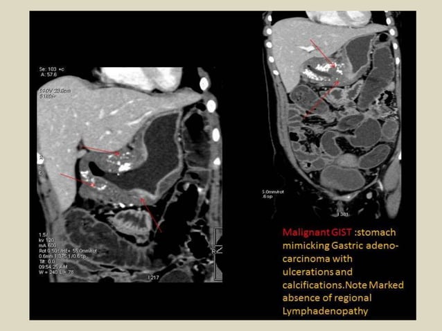 Presentation1, radiological imaging of gastro intestinal stromal tumour ...