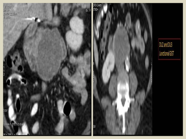 Presentation1, radiological imaging of gastro intestinal stromal tumour ...