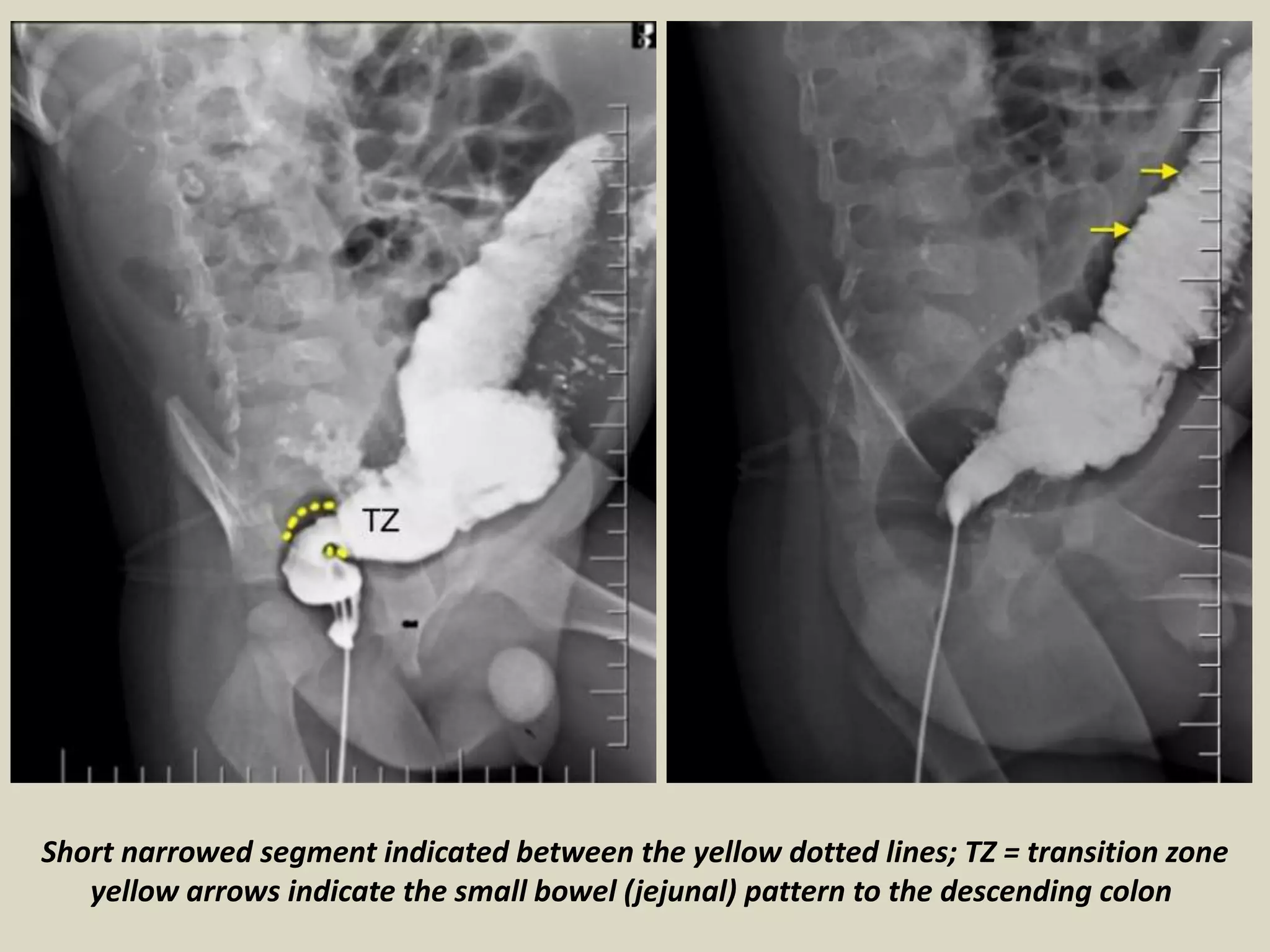 Long Segment Presentation1, radiological imaging of hirshsprung disease. | PPTX