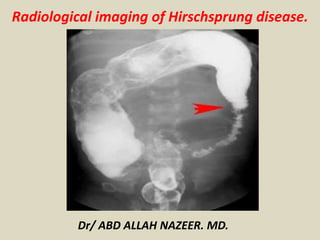 Dr/ ABD ALLAH NAZEER. MD.
Radiological imaging of Hirschsprung disease.
 