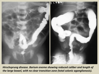 Long Segment Presentation1, radiological imaging of hirshsprung disease. | PPTX