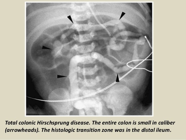 Presentation1, radiological imaging of hirshsprung disease.