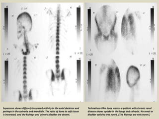 Superscan Bone Presentation1, radiological imaging of hyperparathyroidism. | PPTX