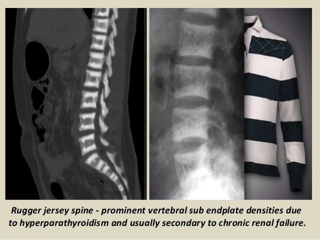 hyperparathyroidism radiological presentation1 rugger endplate vertebral