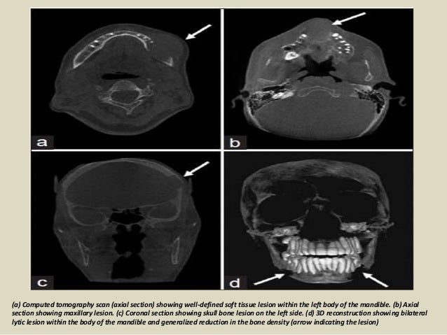 hyperparathyroidism presentation1 radiological lesion ultrasonography