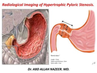 Radiological Imaging of Hypertrophic Pyloric Stenosis.
Dr. ABD ALLAH NAZEER. MD.
 