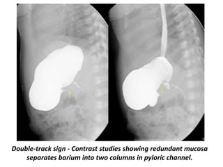 Double Track Sign Pyloric Stenosis